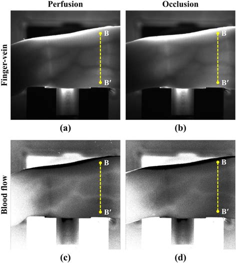 Figure From Imaging Of The Finger Vein And Blood Flow For Anti