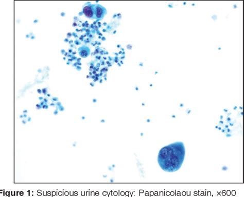 Figure 1 From Urinary Bladder Metastasis From Lung Adenocarcinoma A