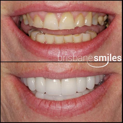 Porcelain Veneers Brisbane Smiles