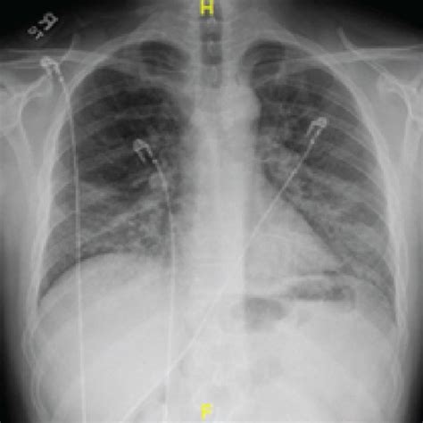 Chest Ct Showing A Large Bulla In The Right Lung Adjacent To The Major