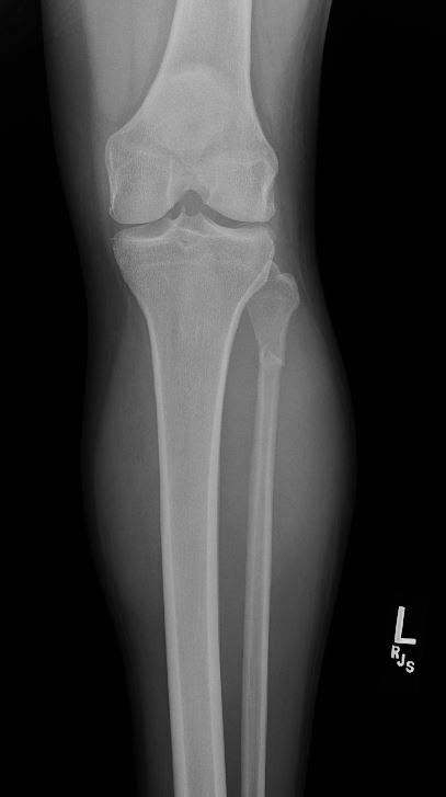 Fibula Fractures Statpearls Ncbi Bookshelf