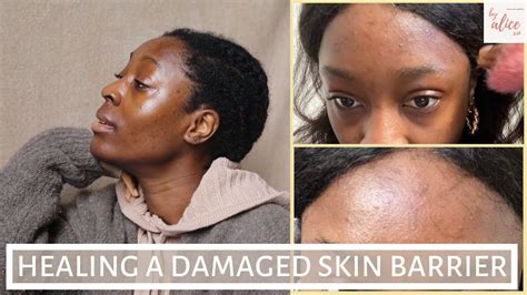 I Damaged My Skin Barrier Here S How I Fixed It Repairing My