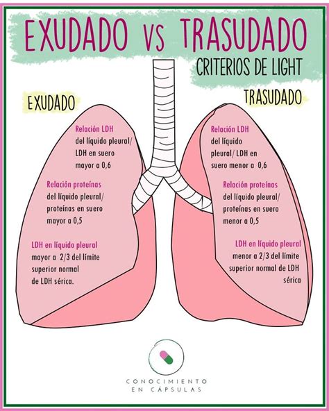 Criterios De Light Para Clasificar Los Derrames Pleurales Cosas De