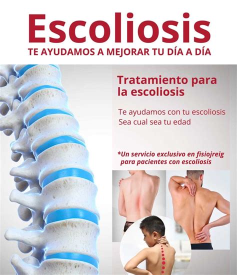 Tratamiento De La Escoliosis Cl Nica De Fisioterapia En Alcoy