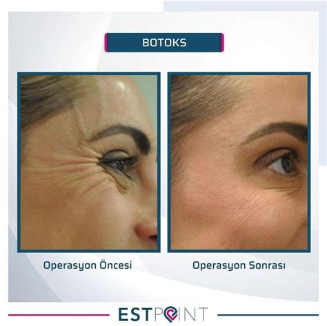 Botoks Ncesi Sonras Stanbul Botox Estpoint Estetik