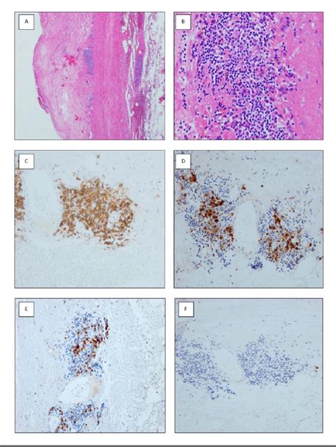 Figure 1 From Synchronous Microscopic Epstein Barr VirusPositive