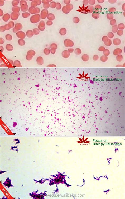 Leukemia Blood Smear