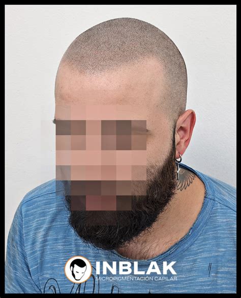 Ejemplos de línea frontal con la micropigmentación capilar en INBLAK