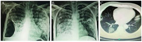 Chest radiography studies. (A,B) shows chest radiography study of Case ...