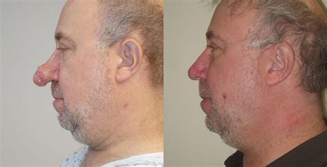 Rhinophyma Removal Diagnosis Treatment Cost