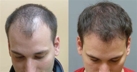 Why Neograft Hair Transplant Hair Restoration Savannah