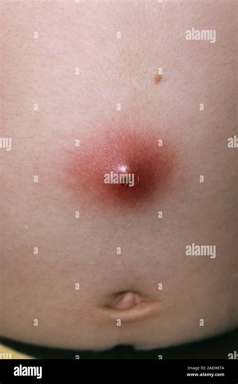 Close Up Showing An Abscess On The Abdomen Of A Seven Year Old Girl