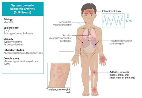 Systemic Juvenile Idiopathic Arthritis Still Disease MEDizzy