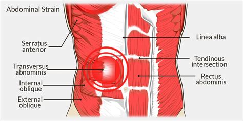 Abdominal Muscle Strain - Symptoms and Treatment - 9INE POINT