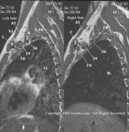 D Brachial Plexus Mri Mra Mrv D Mri Sagittal Sequence