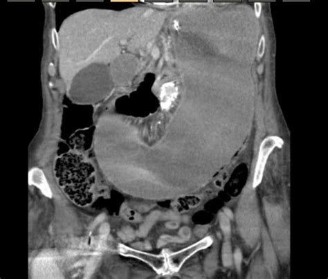 Ct Scan Markedly Distended Stomach And Duodenum With Greater Curvature