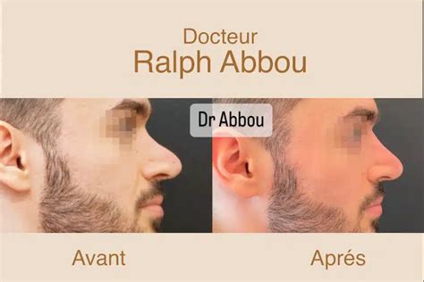 Rhinoplastie médicale Paris Dr Ralph Abbou