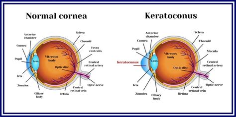 Does Keratoconus Ever Lead to Blindness? – NVISION