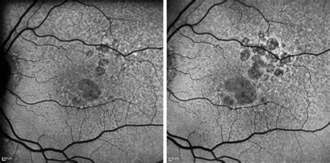 First Dry Amd Treatment On Horizon Optometry Australia