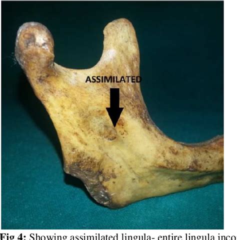 Figure 1 From A Morphometric And Morphological Study Of Mandibular