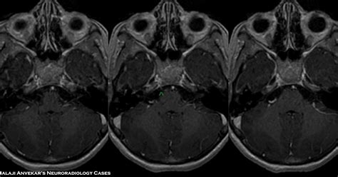 6th Cranial Nerve Palsy Mri