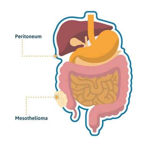 Peritoneal Mesothelioma: Causes, Treatment & Survival Rates