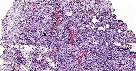 Pathology Outlines Nephrogenic Metaplasia