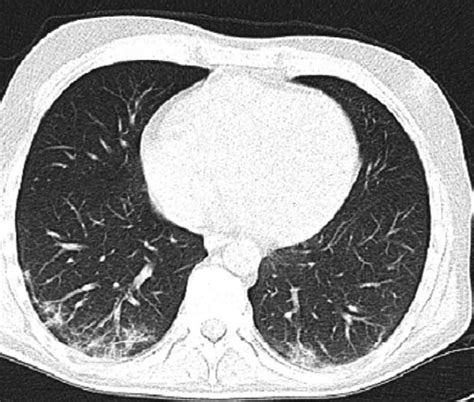 CT Shows Patchy Ground Glass Opacities Affecting The Subpleural Lung