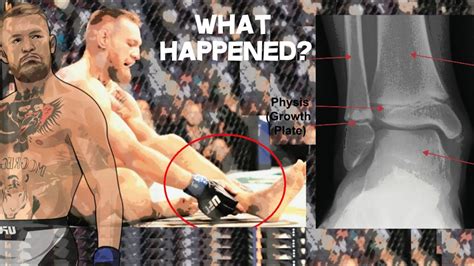 How Did Conor Mcgregor Break His Leg What Actually Happened Ufc 264 Youtube