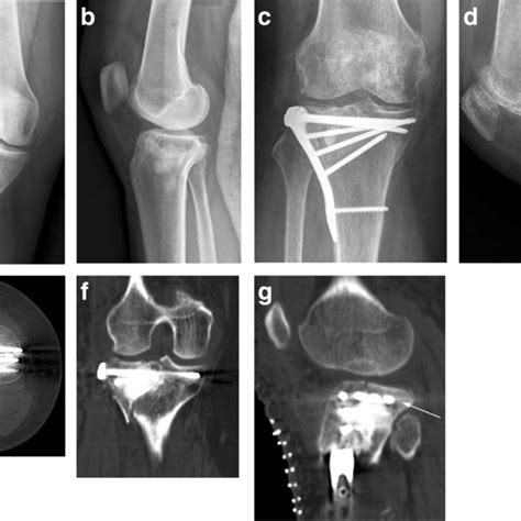 Pdf Comparison Of Extended Anterolateral Approach In Treatment Of