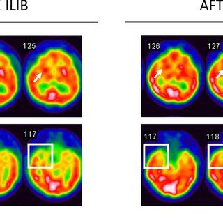 The brain SPECT images of the patient. In A, SPECT showed a decrease of... | Download Scientific ...