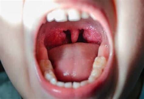 Virale Pharyngitis: Diagnose und Behandlung - Besser Gesund Leben