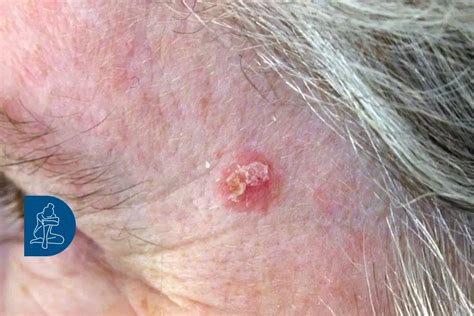 Actinic Or Solar Keratosis Better To Remove Them