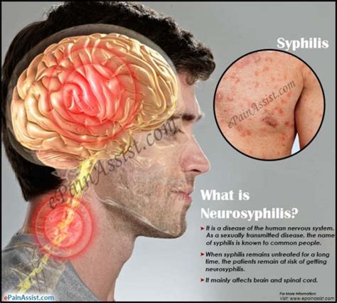 What Neurosyphilis Healthgistnet