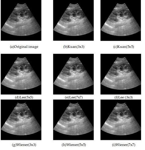 Speckle Noise Reduction In Medical Ultrasound Images Intechopen