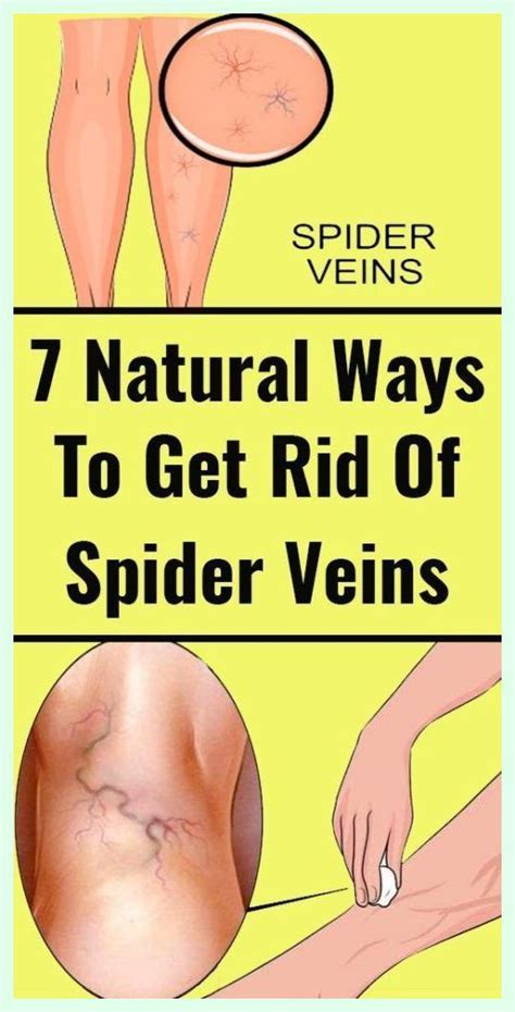 This Natural Ingredient Will Help You Get Rid Of Varicose Veins In Just