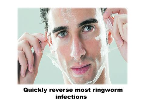 Ppt How To Get Rid Of Ringworm Overnight What Is Ringworm And How Do You Get It Best Cure