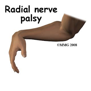 USMLE Review Notes: Radial Nerve Palsy