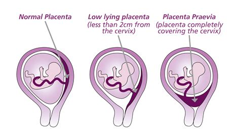 Placenta Praevia Placenta Accreta And Vasa Praevia Leeds Teaching