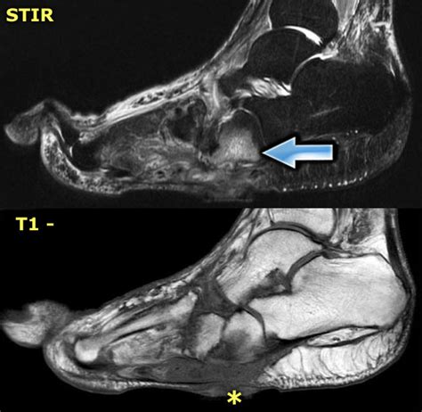 Osteomyelitis X Ray Foot