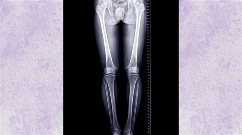 Alineacion Correcta Del Cuerpo Archivos UltraMed Plantillas