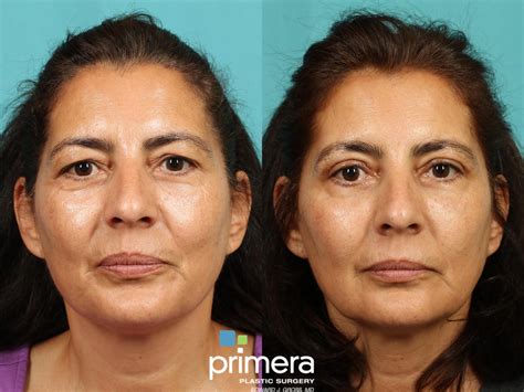 Blepharoplasty Before And After Pictures Case 838 Orlando And Tampa