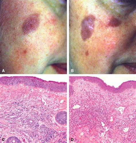 Granuloma Faciale A Clinicopathologic Study Of 66 Patients Journal