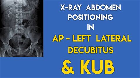 X Ray Abdomen Positioning X Ray Kub Positioning X Ray Abdomen Kub