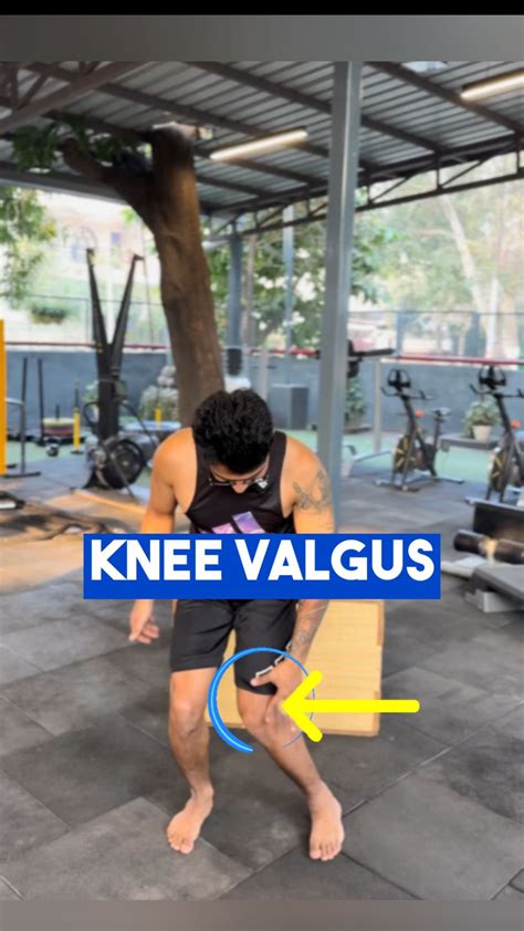 Sidharth Uniyal | Knee valgus involves the inward collapse of the knee