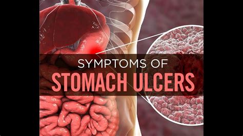 Stomach Ulcers Symptoms Causes And Diagnosis YouTube