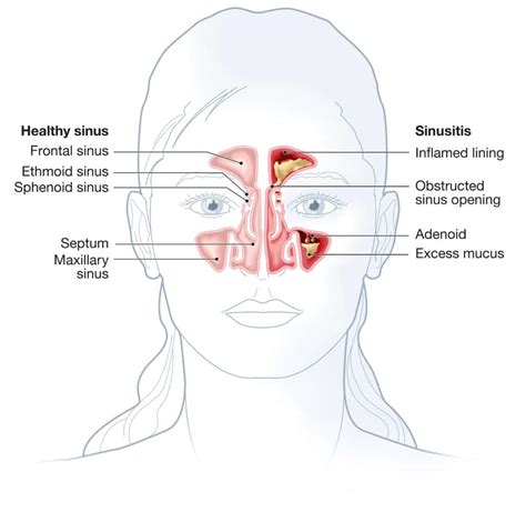 Anatomy Of Sinus Infection