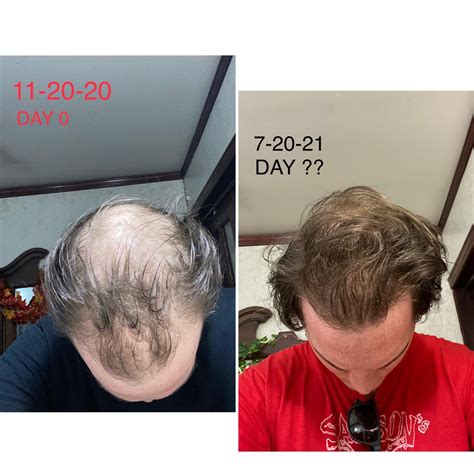 8 Month Results W Finasteride And Minoxidil R Malehairadvice