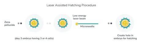 Laser Assisted Hatching In Ivf Art Fertility Clinic