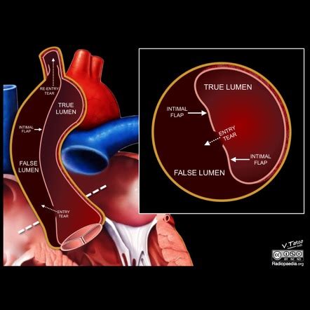 Aortic dissection | Radiology Reference Article | Radiopaedia.org